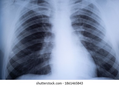 3,058 Lung Trauma Images, Stock Photos & Vectors | Shutterstock