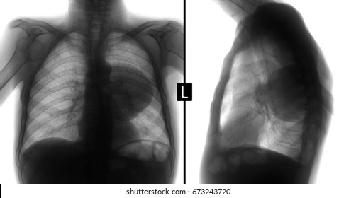 X-ray Lungs: Volume Formation Of The Left Lung. Negative.