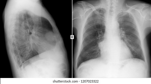 Xray Lungs Volume Formation Mediastinum Teratoma Stock Photo 1207023322 ...