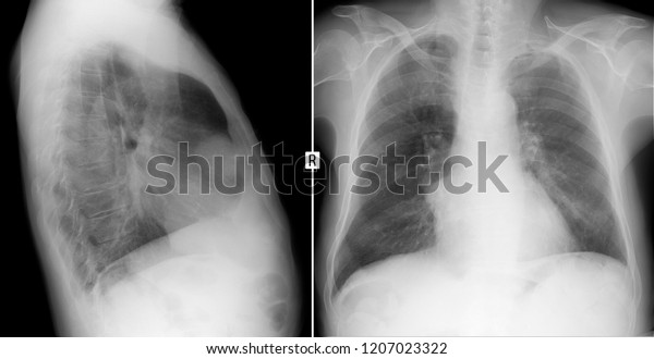 Xray Lungs Volume Formation Mediastinum Teratoma Stock Photo (Edit Now ...