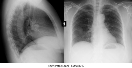 Xray Lungs Volumetric Formation Right Lung Stock Photo 656088742 ...