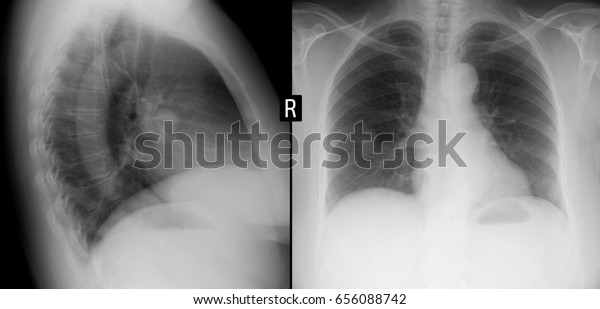 Xray Lungs Volumetric Formation Right Lung Stock Photo 656088742 ...