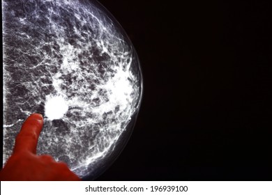 Röntgenbild der Brustdrüse mit Krebs