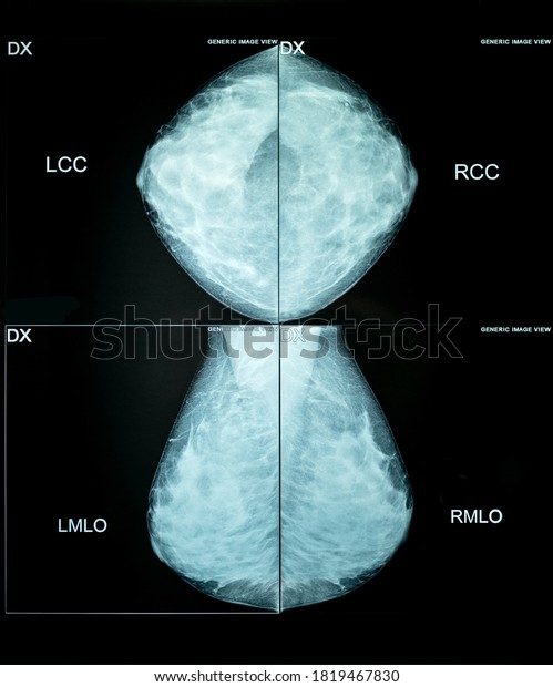 Xray Mammography Cancer Checking Breasts Ful Stock Photo 1819467830 ...