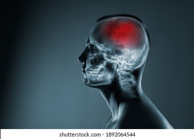 X-ray of a man's head. Cerebral stroke. Brain damage is highlighted by red colour.