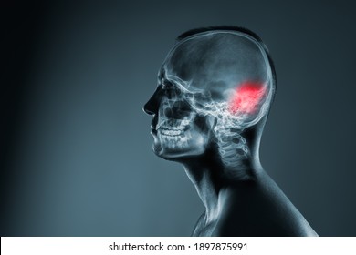 X-ray of a man's head. Medical examination of head injuries. Cerebral stroke. The back of the brain is highlighted by red colour. Others x-ray images in my portfolio.