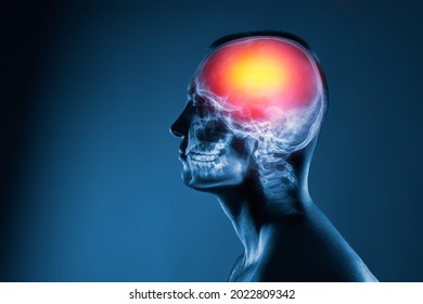 X-ray of a man's head. Medical examination of head injuries. Cerebral stroke. Brain damage is highlighted by red colour. Others x-ray images in my portfolio.