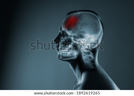 X-ray of a man's head. Medical examination of head injuries. Frontal part of the brain is highlighted by red colour.