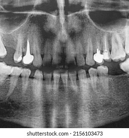 X-ray Of A Man's Jaw 360 Degrees. Very High Noise. Two Implants. Square Image.