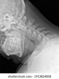 X-ray Medical Picture - Cervical Spine And Head