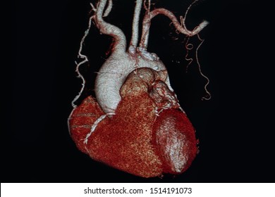 X-ray Medical Scan Heart In Hospital. CTA, CT Angiography 3D Rendering Image, CT Scan. Healthcare And Medical Concept.