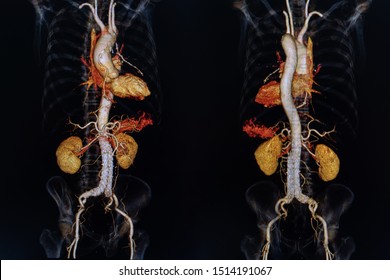 X-ray Medical Scan In Hospital. CTA, CT Angiography 3D Rendering Image, CT Scan. Healthcare And Medical Concept.