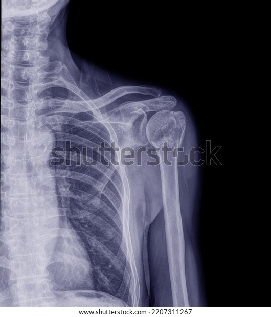 Xray Middleaged Man Broken Collarbone Examined Stock Photo 2207311267