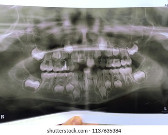 X-ray Of Milk Teeth