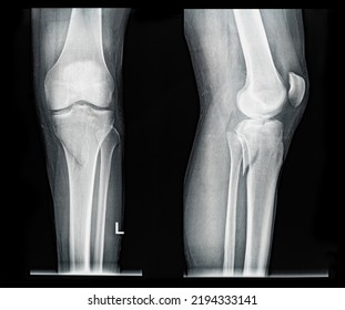 Xray MRI Images Showing Real Fracture Of Broken Leg Bone Under The Knee After Injury