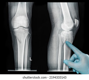 Xray MRI Images Showing Real Fracture Of Broken Leg Bone Under The Knee After Injury Medical Glove Point Out