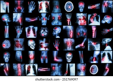 X-ray Multiple Disease Of Child And Adult ( Stroke , Arthritis , Fracture , Tuberculosis , Brain Tumor , Bowel Obstruction  , Kidney Stone , Spondylosis , Spondylolisthesis , Osteoarthritis Knee ,etc)