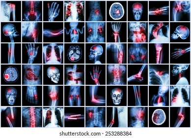 X-ray Multiple Disease Of Child And Adult ( Stroke , Arthritis , Fracture , Tuberculosis , Brain Tumor , Bowel Obstruction  , Kidney Stone , Spondylosis , Spondylolisthesis , Osteoarthritis Knee ,etc)