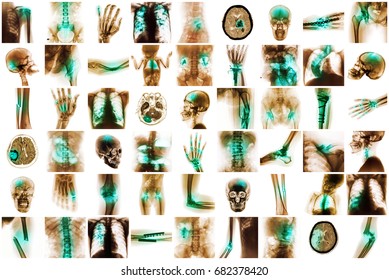 X-ray Multiple Disease Of Child And Adult ( Stroke . Arthritis . Fracture . Tuberculosis . Brain Tumor . Bowel Obstruction . Kidney Stone . Spondylosis . Spondylolisthesis . Osteoarthritis Knee . Etc)