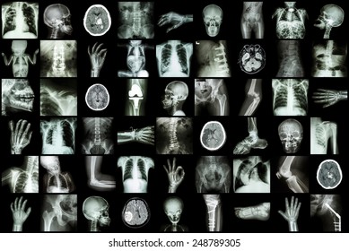 X-ray Multiple Part Of Adult And Child And Disease ( Pulmonary Tuberculosis Stroke Kidney Stone Osteoarthritis Bone Fracture Bowel Obstruction Spondylosis Spondylolisthesis Scoliosis Brain Tumor Etc)