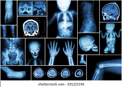 X-ray Multiple Part Of Child 's Body & Multiple Disease ( Stroke , Brain Tumor , Rheumatoid Arthritis , Sinusitis , Gouty Arthritis , Etc)( Skull Chest Lung Heart Spine Arm Hand Pelvis Leg Knee Foot )