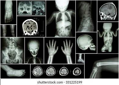 X-ray Multiple Part Of Child 's Body & Multiple Disease ( Stroke , Brain Tumor , Rheumatoid Arthritis , Sinusitis , Gouty Arthritis , Etc)( Skull Chest Lung Heart Spine Arm Hand Pelvis Leg Knee Foot )