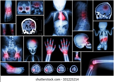 X-ray Multiple Part Of Child 's Body & Multiple Disease ( Stroke , Brain Tumor , Rheumatoid Arthritis , Sinusitis , Gouty Arthritis , Etc)( Skull Chest Lung Heart Spine Arm Hand Pelvis Leg Knee Foot )