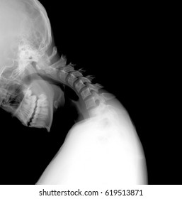 X-ray of neck and cervical spine function test lateral (LAT) - Instability
Maximum extension