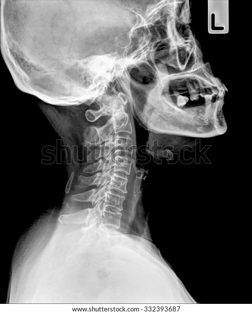 Xray Neck Cervical Spine Side View Stock Photo (Edit Now) 332393687