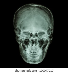 X-ray normal asian skull (Thai people)