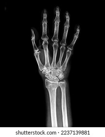 X-ray normal hands on black background - Shutterstock ID 2237139881