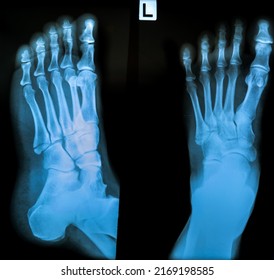 Xray Normal Human Foot Anatomy Stock Photo 2169198585 | Shutterstock