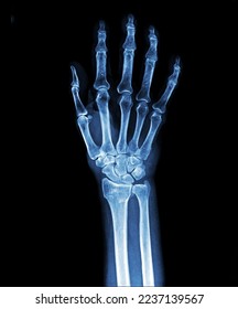 X-ray normal human hands (front) on black background - Shutterstock ID 2237139567