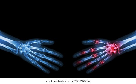 X-ray Normal Person Is Shaking Hand With Arthritis Hand Person