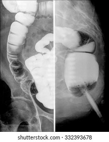 X-ray With Opaque Contrast Medium That Shows Intestine