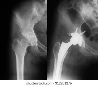 X-ray  of osteoarthritis (anteroposterior view), a 36 years old woman, preoperative (left) and immediate postoperative(right).