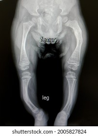 The X-ray Of Osteogenic Imperfecta (OI Type III) Is Shown Severe Varus Deformity Of Lower Extremities. It's Poor Mechanical Axis  And Can't Walk.