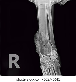 X-ray Of Osteosarcoma Bone Tumor Foreleg  A Dog.