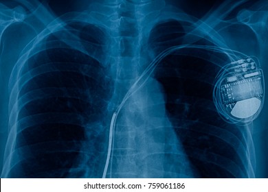 Xray Pacemaker Cell 