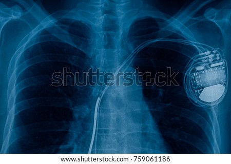 xray pacemaker cell 