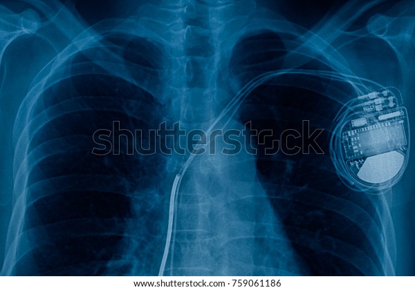 xray pacemaker cell\
