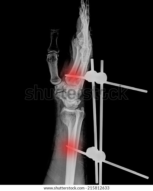 Xray Pain Hand Hand Posteroanterior On Stock Photo 215812633 | Shutterstock