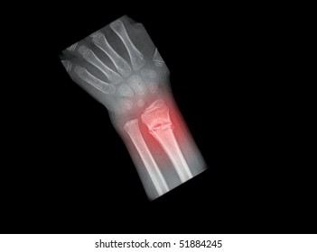 Xray Painful Arm Fracture Isolated On Stock Photo 51884245 | Shutterstock