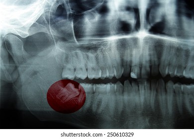 X-ray, Panoramic  RTG , Radiology, Photo Showing Skew Wisdom Tooth (eight Tooth) For Removal 