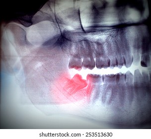 X-ray, Panoramic RTG , Radiology, Photo Showing Skew Wisdom Tooth (eight Tooth) For Removal - Purple Effect