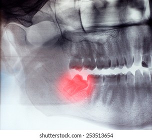 X-ray, Panoramic RTG , Radiology, Photo Showing Skew Wisdom Tooth (eight Tooth) For Removal - Black And White