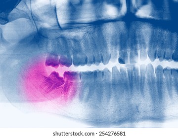 X-ray, Panoramic RTG , Radiology, Photo Showing Skew Wisdom Tooth (eight Tooth) For Removal - Black And White