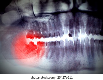 X-ray, Panoramic RTG , Radiology, Photo Showing Skew Wisdom Tooth (eight Tooth) For Removal - Black And White