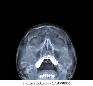 X Ray Sinus High Res Stock Images Shutterstock