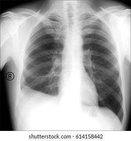 x-ray the patient with the disease of pleurisy. The inflammation around the lungs.